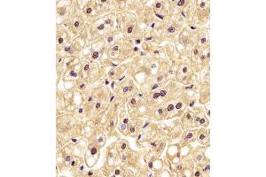 (ABIN6242522 and ABIN6577190) staining PGK1 in human liver tissue sections by Immunohistochemistry (IHC-P - paraformaldehyde-fixed, paraffin-embedded sections). (PGK1 antibody  (AA 1-417))