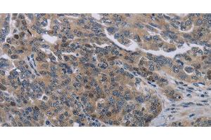 Immunohistochemistry of paraffin-embedded Human ovarian cancer tissue using NOX1 Polyclonal Antibody at dilution 1:50 (NOX1 antibody)