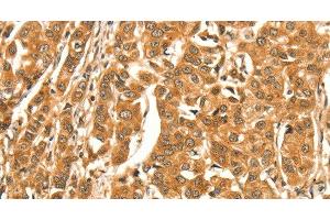 Immunohistochemistry of paraffin-embedded Human breast cancer tissue using DIRAS1 Polyclonal Antibody at dilution 1:52 (DIRAS1 antibody)