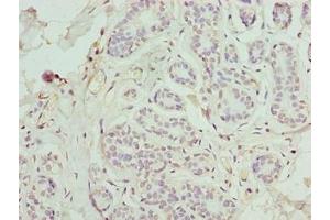 Immunohistochemistry of paraffin-embedded human breast cancer using ABIN7165550 at dilution of 1:100 (FAM71F1 antibody  (AA 121-343))