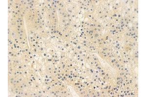 ABIN6259252 and ABIN6273962 at 1/100 staining human hepatocellular carcinoma by IHC-P.