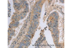 Immunohistochemistry of Human colon cancer using MAGED1 Polyclonal Antibody at dilution of 1:30 (MAGED1 antibody)