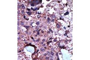 Formalin-fixed and paraffin-embedded human cancer tissue reacted with the primary antibody, which was peroxidase-conjugated to the secondary antibody, followed by AEC staining. (PKLR antibody  (N-Term))