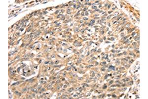 The image on the left is immunohistochemistry of paraffin-embedded Human lung cancer tissue using ABIN7191289(LONP1 Antibody) at dilution 1/25, on the right is treated with synthetic peptide. (LONP1 antibody)