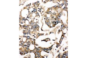 Anti-SLC10A1 antibody, IHC(P) IHC(P): Human Liver Cancer Tissue (SLC10A1 antibody  (Middle Region))