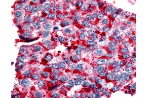 Anti-NPBWR2 / GPR8 antibody IHC of human Lung, Non-Small Cell Carcinoma. (NPBWR2 antibody  (Cytoplasmic Domain))