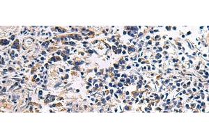 Immunohistochemistry of paraffin-embedded Human breast cancer tissue using DRGX Polyclonal Antibody at dilution of 1:45(x200) (DRGX antibody)