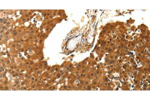 Immunohistochemistry of paraffin-embedded Human breast cancer using SKP1 Polyclonal Antibody at dilution of 1:30 (SKP1 antibody)
