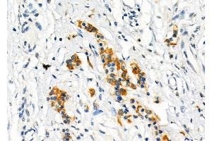 ABIN6262693 and ABIN6273257 at 1/100 staining Human pancreatic cancer by IHC-P. (ITLN1/Omentin antibody  (C-Term))