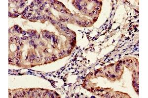 Immunohistochemistry of paraffin-embedded human endometrial cancer using ABIN7161170 at dilution of 1:100