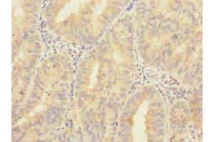 Immunohistochemistry of paraffin-embedded human endometrial cancer using ABIN7176401 at dilution of 1:100 (ZNF582 antibody  (AA 1-300))