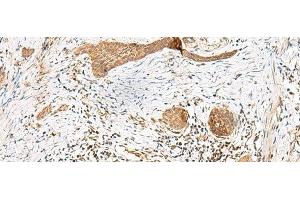 Immunohistochemistry of paraffin-embedded Human esophagus cancer tissue using GSTM2 Polyclonal Antibody at dilution of 1:50(x200) (GSTM2 antibody)