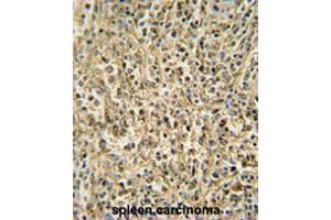 RNT2 antibody (N-term) immunohistochemistry analysis in formalin fixed and paraffin embedded human spleen carcinoma followed by peroxidase conjugation of the secondary antibody and DAB staining. (RNASET2 antibody  (N-Term))