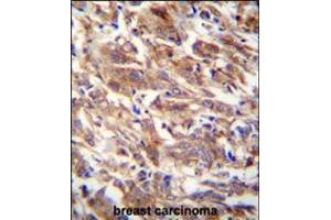 FBXW12 antibody immunohistochemistry analysis in formalin fixed and paraffin embedded human breast carcinoma followed by peroxidase conjugation of the secondary antibody and DAB staining. (FBXW12 antibody  (C-Term))