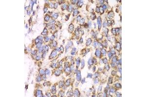 Immunohistochemistry of paraffin-embedded human esophageal cancer using ATP5A1 antibody. (ATP5A1 antibody)