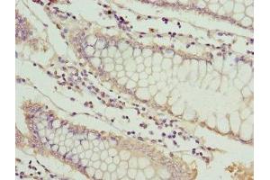 Immunohistochemistry of paraffin-embedded human colon cancer using ABIN7159525 at dilution of 1: 100