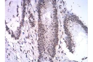 Immunohistochemical analysis of paraffin-embedded colon cancer tissues using ASH2L mouse mAb with DAB staining. (ASH2L antibody  (AA 493-628))