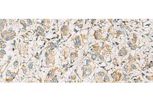 Immunohistochemistry of paraffin-embedded Human liver cancer tissue using PDE4DIP Polyclonal Antibody at dilution of 1:60(x200) (PDE4DIP antibody)