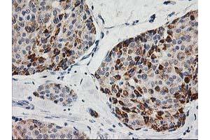 Immunohistochemical staining of paraffin-embedded Adenocarcinoma of Human breast tissue using anti-AK4 mouse monoclonal antibody.