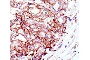 IHC analysis of FFPE human hepatocarcinoma tissue stained with the Mib1 antibody (MIB1 antibody  (AA 13-42))