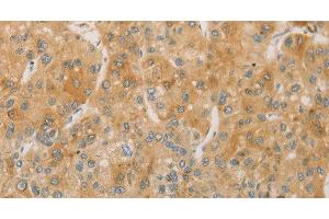 Immunohistochemistry of paraffin-embedded Human liver cancer using ACSL4 Polyclonal Antibody at dilution of 1:60 (ACSL4 antibody)