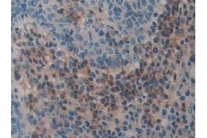 Detection of THBS3 in Human Skin cancer Tissue using Polyclonal Antibody to Thrombospondin 3 (THBS3) (THBS3 antibody  (AA 670-921))