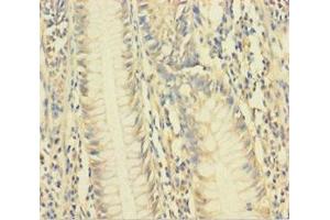 Immunohistochemistry of paraffin-embedded human colon cancer using ABIN7175481 at dilution of 1:100 (VAMP5 antibody  (AA 1-72))