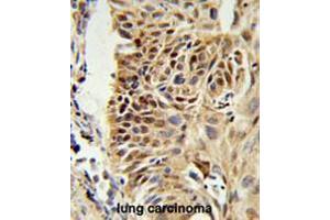 CIRBP Antibody (C-term) IHC analysis in formalin fixed and paraffin embedded human lung carcinoma followed by peroxidase conjugation of the secondary antibody and DAB staining. (CIRBP antibody  (C-Term))