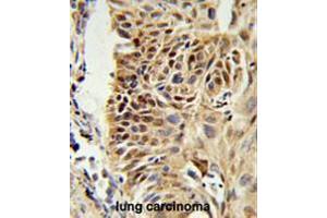 CIRBP Antibody (C-term) IHC analysis in formalin fixed and paraffin embedded human lung carcinoma followed by peroxidase conjugation of the secondary antibody and DAB staining.