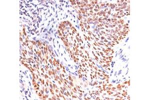IHC staining of lung squamous cell carcinoma with p40 antibody. (p40 (p63 Delta) (AA 5-17) antibody)