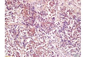 Formalin-fixed and paraffin embedded human lung carcinoma labeled with Anti-PP2A alpha + beta Polyclonal Antibody, Unconjugated (ABIN723875) at 1:200 followed by conjugation to the secondary antibody and DAB staining (PP2A alpha/beta antibody  (AA 205-309))