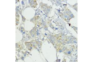 Immunohistochemistry of paraffin-embedded human mammary cancer using SOCS6 antibody (ABIN6128785, ABIN6148273, ABIN6148274 and ABIN6225294) at dilution of 1:100 (40x lens). (SOCS6 antibody  (AA 1-210))