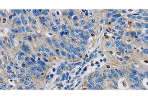 Immunohistochemistry of paraffin-embedded Human ovarian cancer tissue using GRIA3 Polyclonal Antibody at dilution 1:50 (Glutamate Receptor 3 antibody)