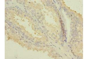 Immunohistochemistry of paraffin-embedded human prostate cancer using ABIN7163163 at dilution of 1:100 (PIK3R1 antibody  (Regulatory Subunit A))