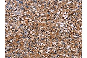 The image on the left is immunohistochemistry of paraffin-embedded Human prostate cancer tissue using ABIN7130450(NPM3 Antibody) at dilution 1/60, on the right is treated with fusion protein. (NPM3 antibody)