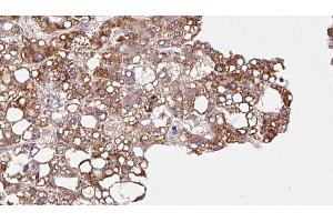 ABIN6272902 at 1/100 staining Human liver cancer tissue by IHC-P.