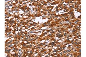 The image on the left is immunohistochemistry of paraffin-embedded Human thyroid cancer tissue using ABIN7190842(GPHN Antibody) at dilution 1/30, on the right is treated with synthetic peptide.