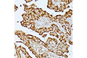 Immunohistochemistry of paraffin-embedded human thyroid cancer using HMGCS2 antibody (ABIN7265329) at dilution of 1:100 (40x lens). (HMGCS2 antibody  (AA 269-508))