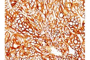 Formalin-fixed, paraffin-embedded human Colon Carcinoma stained with Cytokeratin 18 Mouse Monoclonal Antibody (DA7). (Cytokeratin 18 antibody)