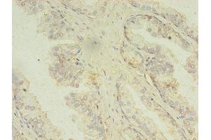 Immunohistochemistry of paraffin-embedded human prostate cancer using ABIN7159988 at dilution of 1:100 (MAPK13 antibody  (AA 1-365))