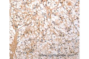 Immunohistochemistry of Human lung cancer using HCRTR1 Polyclonal Antibody at dilution of 1:100 (HCRTR1 antibody)
