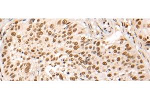 Immunohistochemistry of paraffin-embedded Human lung cancer tissue using HOXA7 Polyclonal Antibody at dilution of 1:70(x200) (HOXA7 antibody)