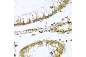 Immunohistochemistry of paraffin-embedded human colon carcinoma using PMPCB antibody (ABIN5972414) at dilution of 1/100 (40x lens). (PMPCB antibody)