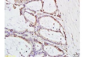 Formalin-fixed and paraffin embedded: human colon carcinoma labeled with Anti-MTLC Polyclonal Antibody , Unconjugated at 1:200, followed by conjugation to the secondary antibody and DAB staining (Myc Target 1 antibody  (AA 21-100))