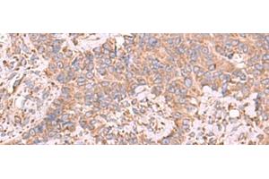 Immunohistochemistry of paraffin-embedded Human ovarian cancer tissue using EEF1D Polyclonal Antibody at dilution of 1:65(x200) (EEF1D antibody)