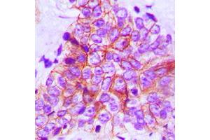 Immunohistochemical analysis of FOP staining in human breast cancer formalin fixed paraffin embedded tissue section. (FGFR1OP antibody  (C-Term))