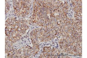 Immunoperoxidase of monoclonal antibody to PPOX on formalin-fixed paraffin-embedded human lung, adenosquamous cell carcinoma. (PPOX antibody  (AA 378-477))