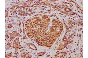 IHC image of ABIN7144920 diluted at 1:100 and staining in paraffin-embedded human pancreatic cancer performed on a Leica BondTM system. (ABCD4 antibody  (AA 335-606))