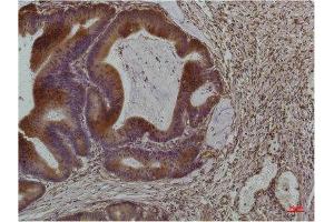 Immunohistochemistry (IHC) analysis of paraffin-embedded Human Colon Carcinoma using Smad3 Mouse Monoclonal Antibody diluted at 1:200.