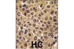 Formalin-fixed and paraffin-embedded human breast carcinoma tissue reacted with CDC25B antibody (Center), which was peroxidase-conjugated to the secondary antibody, followed by DAB staining. (CDC25B antibody  (AA 331-360))